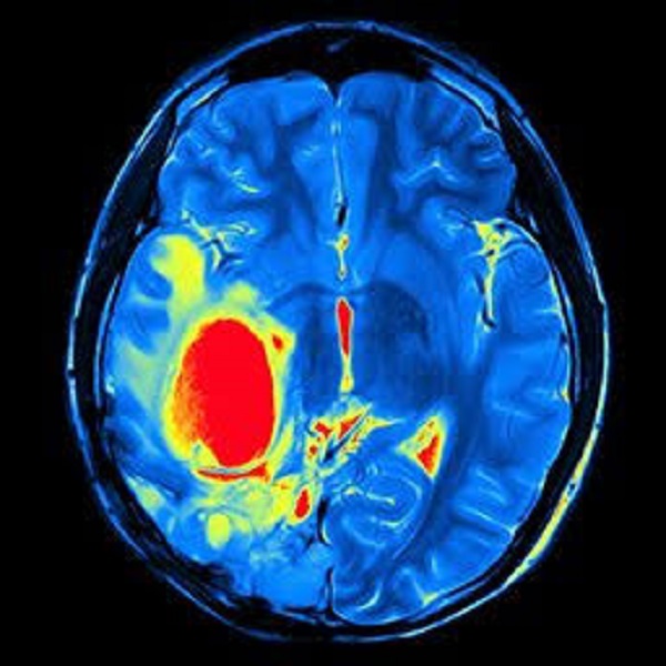 beyin tümörü tedavisi 